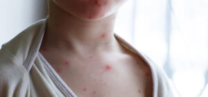 В Минздраве рассказали, какая вероятность распространения в Украине обезьяньей оспы 