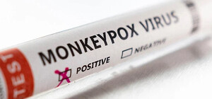В Украине зафиксировали первый случай заболевания обезьяньей оспы