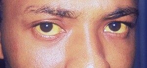 В Украине подтвердилась вспышка вирусного гепатита А: что это и как лечить?