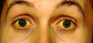 В Днепропетровской области обнаружили больных гепатитом А