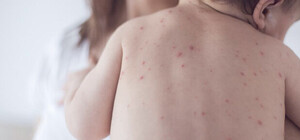 Вспышка кори: Киевские медики призывают к вакцинации