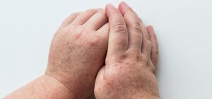 В Одесской области возросла заболеваемость скарлатиной: есть летальный случай