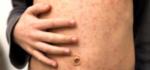 Зафиксировали коклюш и корь: какая эпидситуация в Одесской области 