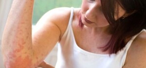 В Днепре заболеваемость чесоткой выросла на 20%