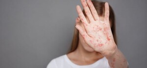 В соцсетях распространяют фейк о вспышке кори в Одессе