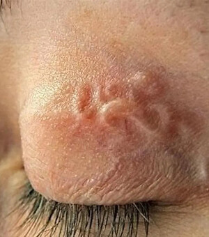 Дістали паразита з повіки: у Запоріжжі виявили випадок дирофіляріозу – що це та як вберегтися