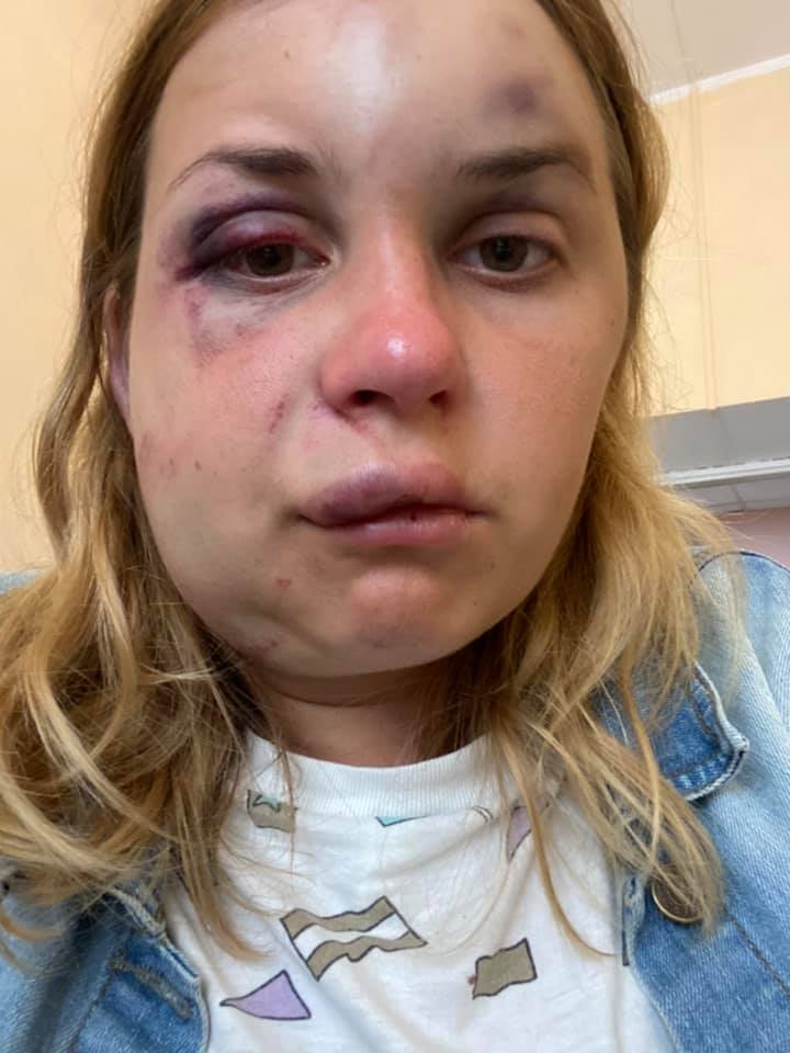 Так выглядит Анастасия после инцидента. Источник фото: Facebook